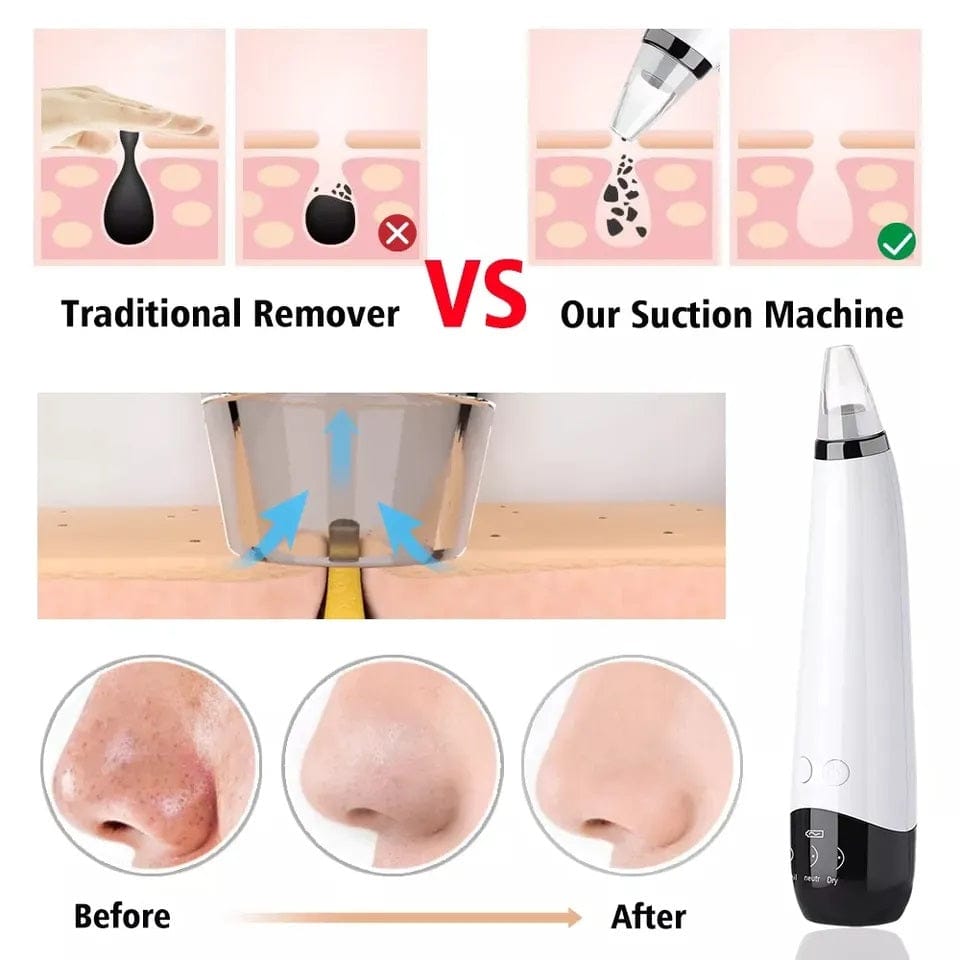 Blackheads Removal