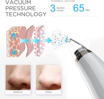 Blackheads Removal